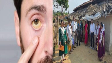 Jaundice In Surajpur