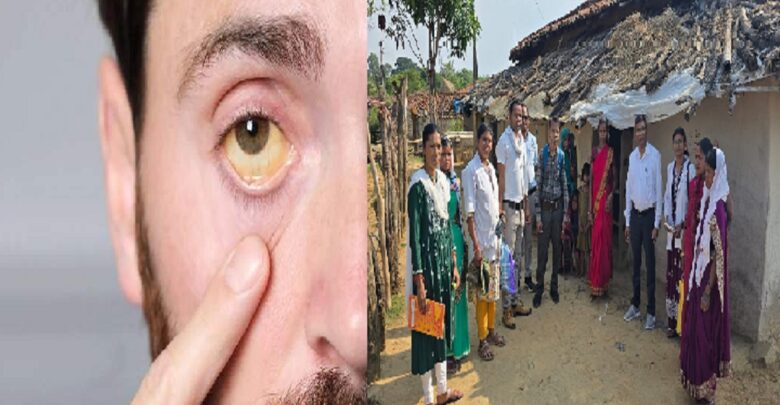 Jaundice In Surajpur